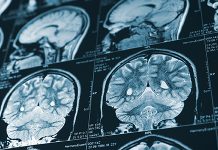 Life-Saving Stroke Therapy Earns NIH’s Top Score