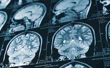 Life-Saving Stroke Therapy Earns NIH’s Top Score